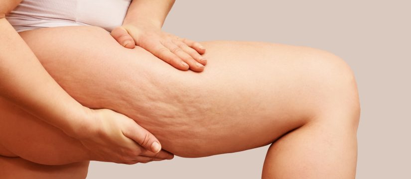 Pronti per la prova costume, come togliere la cellulite!